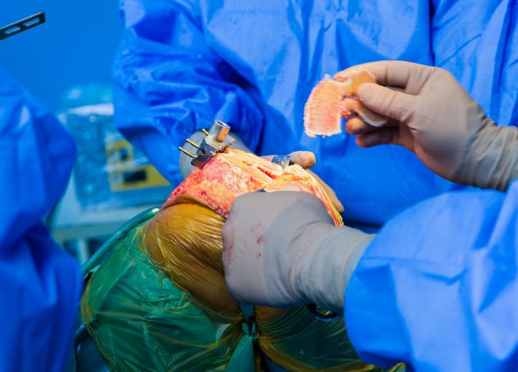 Operace kolene pomocí endoprotézy. Žlutá obarvení kolem otevřeného místa je desinfekce.