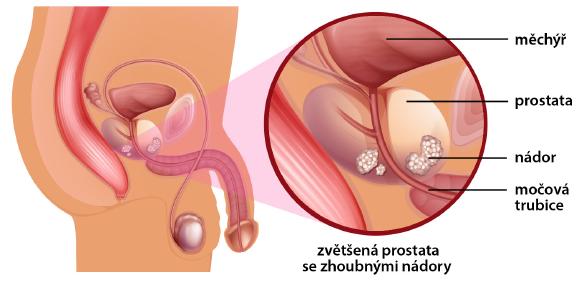 Druhé nejčastější nádorové onemocnění u mužů je rakovina prostaty.