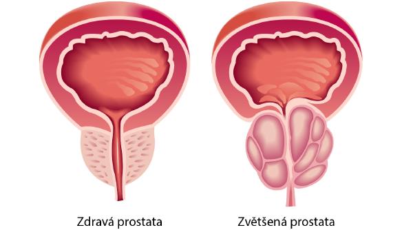 S klesající hladinou testosteronu se prostata zvětšuje.