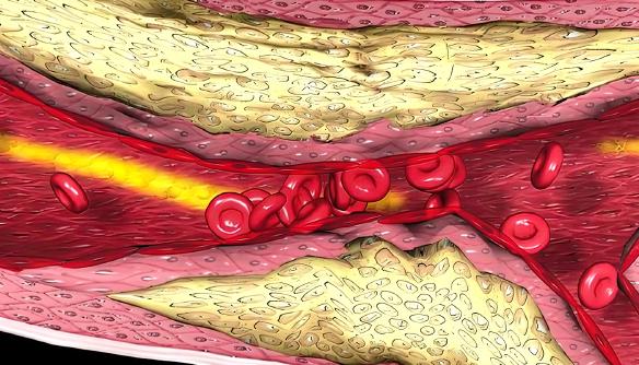 Ukládání tuku (svétlé nánosy s růžovým povrchem) do cévní stěny je častou příčinou snížení průtoku krve a podílí se na sexuálních dysfunkcích