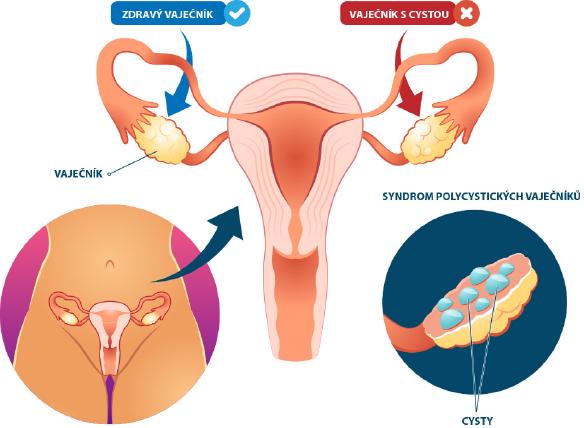 Syndrom polycystických vaječníků způsobuje jejich zvětšení, díky kterému přestávají plnit svoji funkci.