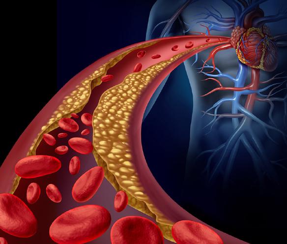 Tuk uložený na stěnách cév (na obrázku žluté nánosy) snižuje jejich průchodnost a omezuje proudění krve